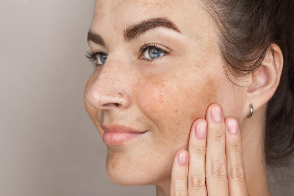 melasma